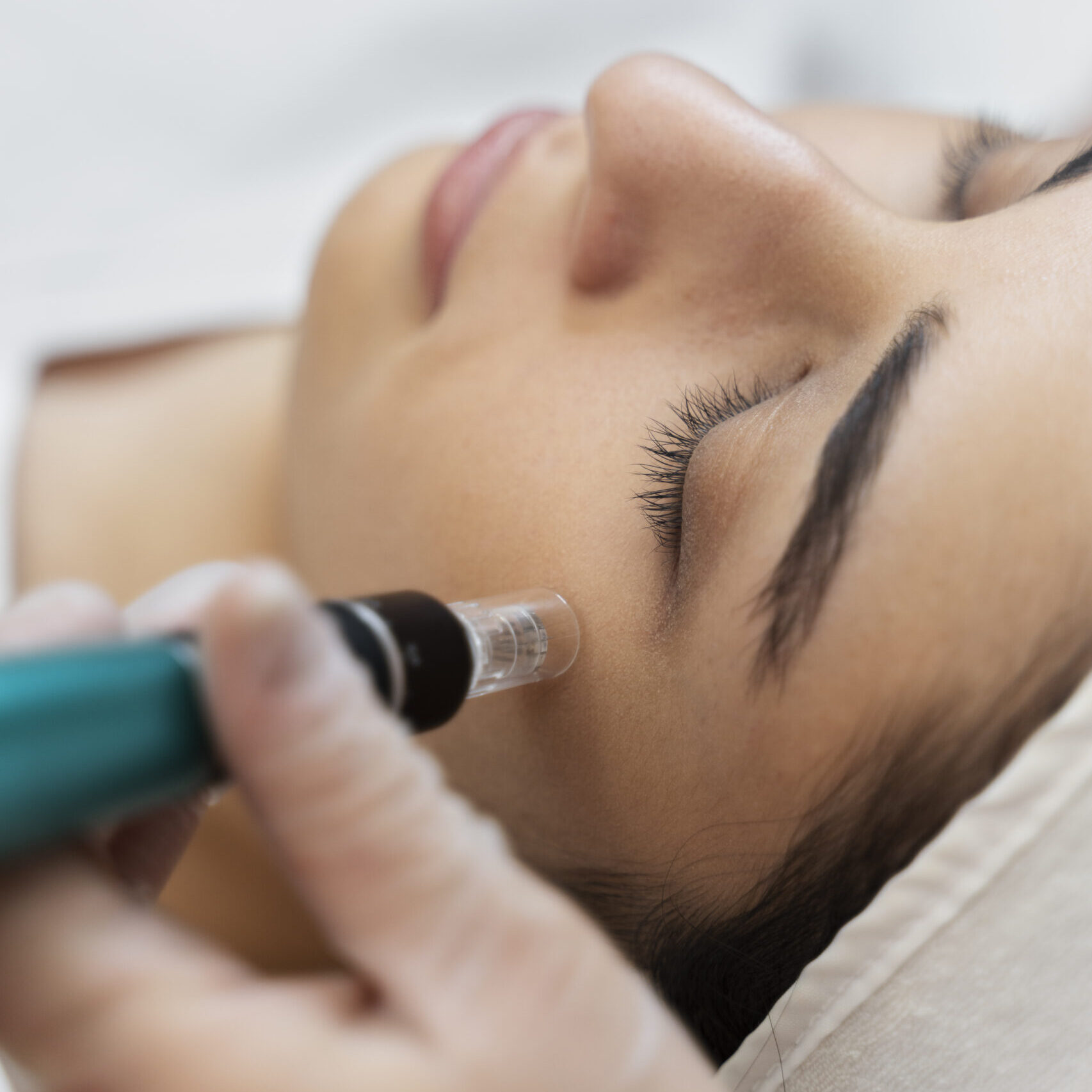 person getting micro needling beauty treatment scaled e1715167320887